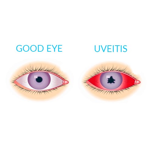 Uveitis