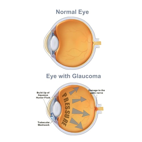 glaucoma_new