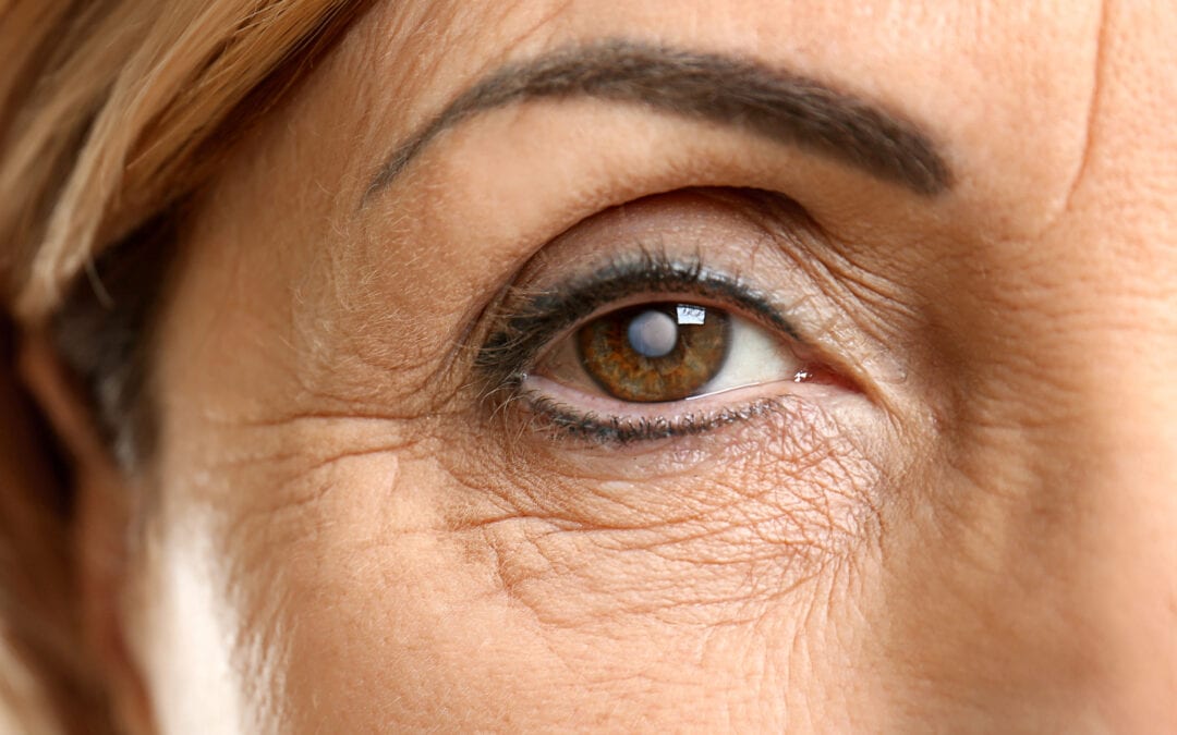 Consultant ophthalmologist examines woman's cataract