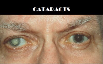 Cataract Book